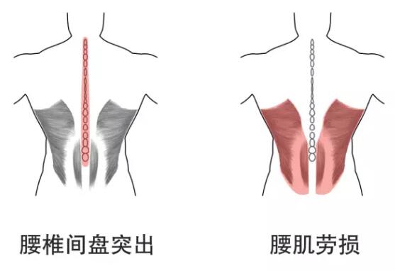 腰椎间盘突出腰肌劳损