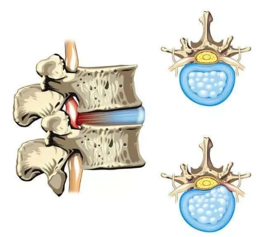 椎间盘解剖