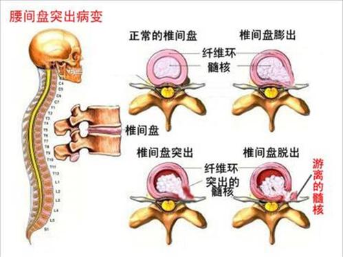 椎间盘突出症